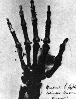 Одна из первых медицинских рентгенограмм - снимок руки нью-йоркского адвоката Батлера Холла с засевшей в ней дробью. М. Пьюпин, 1896 г. (Библиотека Бэрнди, Норуолк, шт. Коннектикут, США.)